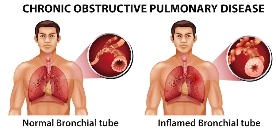 Chronic Obstructive Pulmonary Disease Treatment in Hyderabad